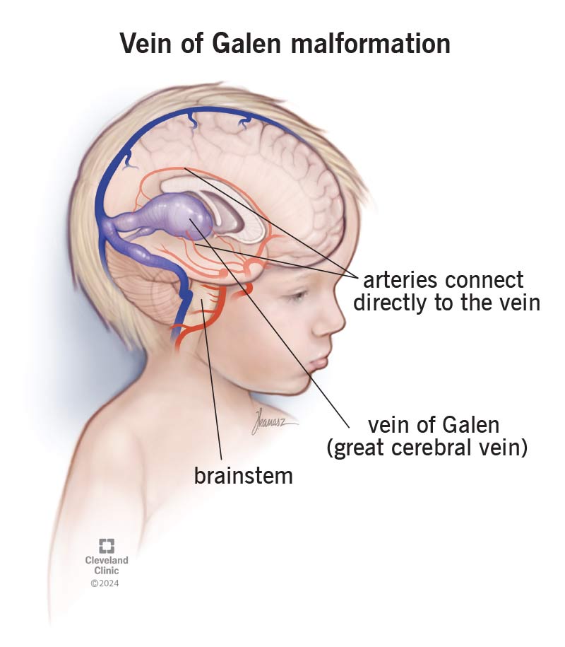 vein of galen malformation
